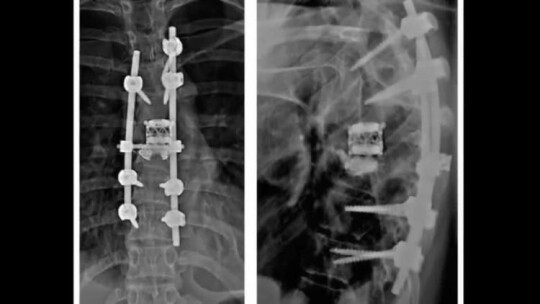 Elbląg. Implant w kręgosłupie  jest jak podnośnik samochodowy